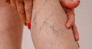 How to Get Rid of Spider Veins?